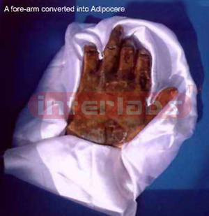 A hand converted into an adipocere
